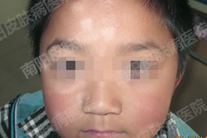 南阳白癜风医院