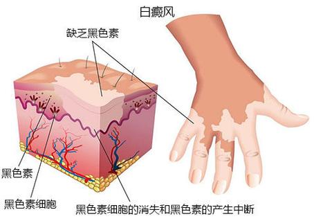 夏季治疗白癜风正当时！抓住黄金期，康复更高效(图1)